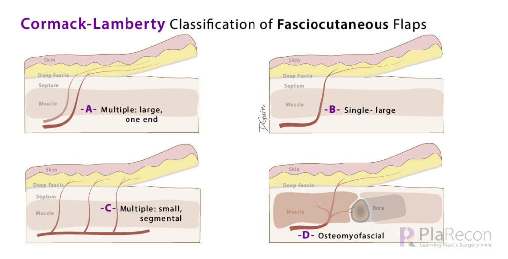 cormack and lamberty flap classification