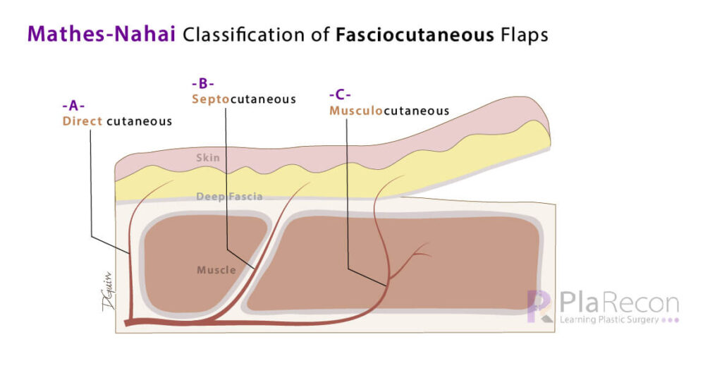 mathes and nahai fasciocutaneous flap classification