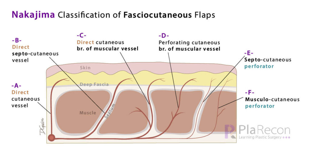 nakajima flap classification