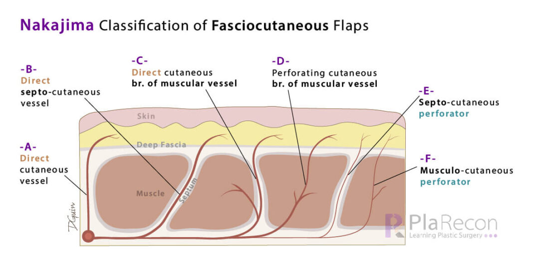 Fasciocutaneous Flap Classifications- Cormack and Lamberty, Mathes and ...