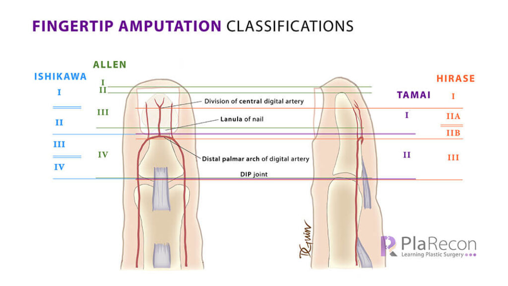 Fingertip amputation classifications- Allen Tamai Ishikawa Hirase Elsahy