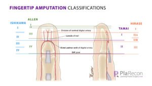 Fingertip Amputation Classifications