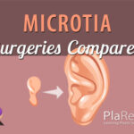Ear Reconstruction in microtia- Brent, Nagata, Firmin- Differences