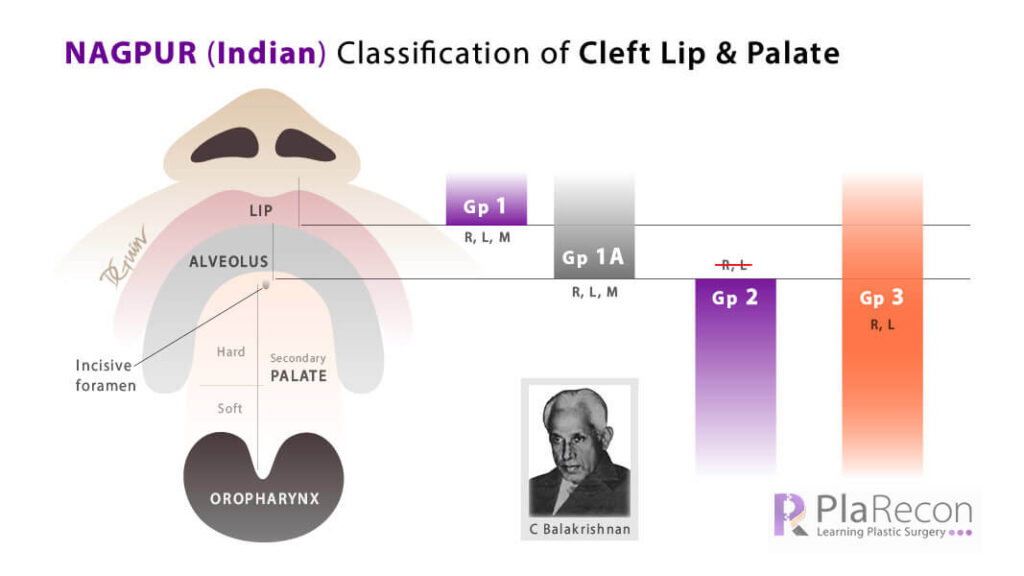 Nagpur classification of cleft lip and palate