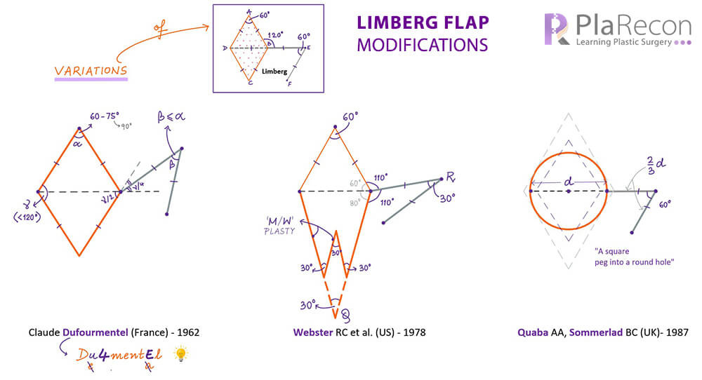 Limberg flap modifications- Dufourmentel flap, Webster flap