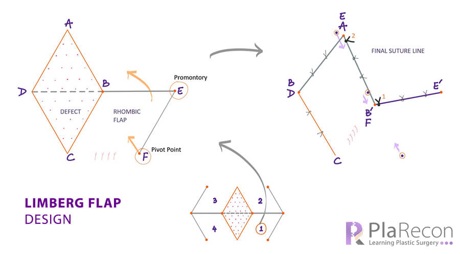 Limberg flap surgery- rhombic, rhomboid